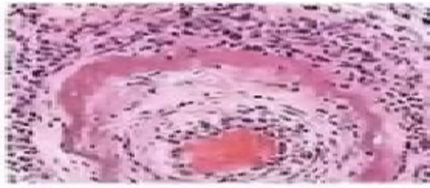 <p>Seen in VESSEL WALLS only; fibrin-like material deposited in walls; causes: vasculitis, malignant hypertension, immune complex deposition</p>