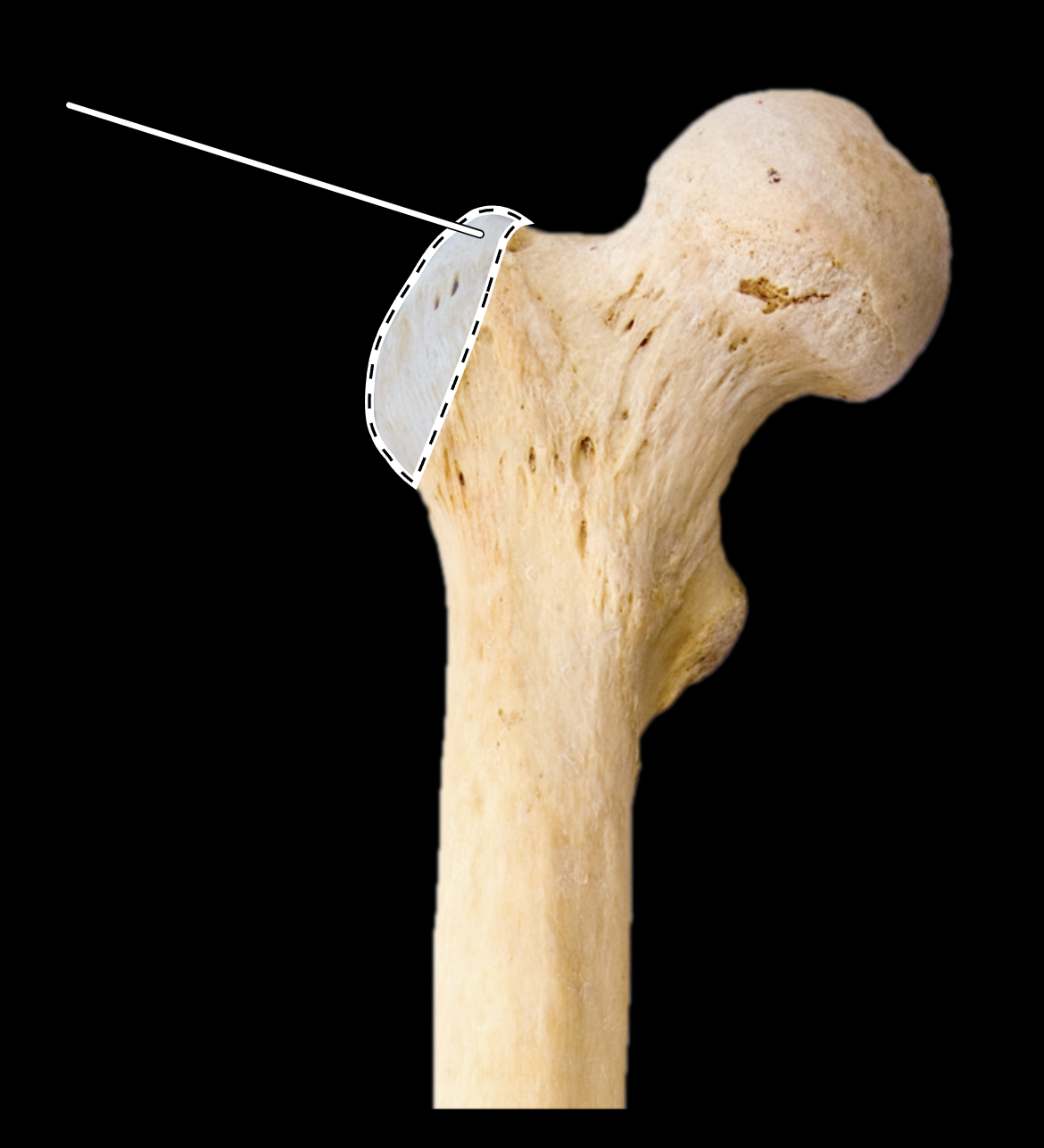 <p>Name the highlighted portion.</p><p>(Femur, anterior view, right side).</p>