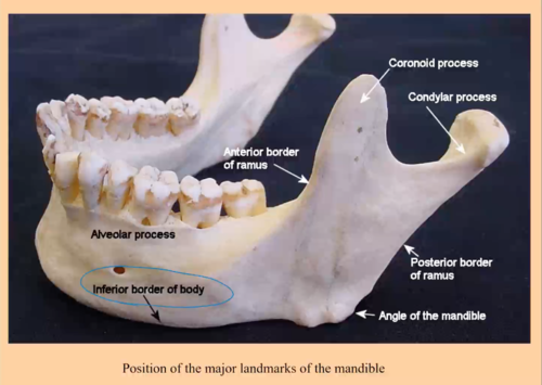 <p>What bony feature of the mandible can be used to find and palpate the facial artery?</p><p>A. Oblique line</p><ul><li><p>A ridge on the mandible, not related to the artery’s palpation point</p></li></ul><p>B. Mental trigone</p><ul><li><p>triangular area over the chin, not where the artery crosses.</p></li></ul><p>C. Angle</p><ul><li><p>Located posteriorly, not the common crossing site of the facial artery.</p></li></ul><p><strong><mark data-color="red" style="background-color: red; color: inherit">D. Premasseteric notch</mark></strong></p><ul><li><p><strong>facial artery</strong> winds around the <strong><u>inferior border of the mandible</u></strong>, typically at the <strong>premasseteric notch</strong></p><ul><li><p>small depression located just <strong>anterior to the masseter muscle, </strong>near the <strong>anterior border of the masseter</strong>.</p></li></ul></li></ul><p></p>