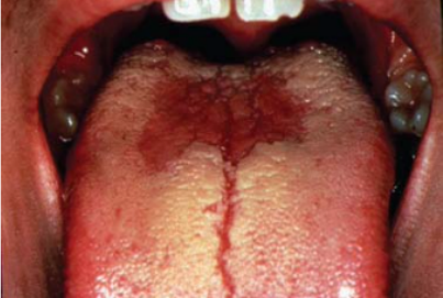 <p>Name the candidiasis associated lesion</p>