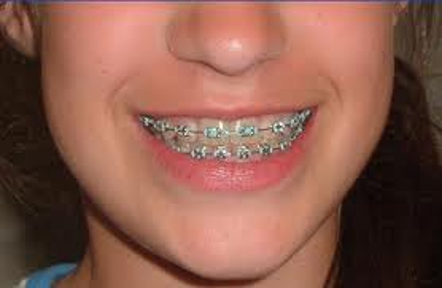 <p>die Zahnspange</p>