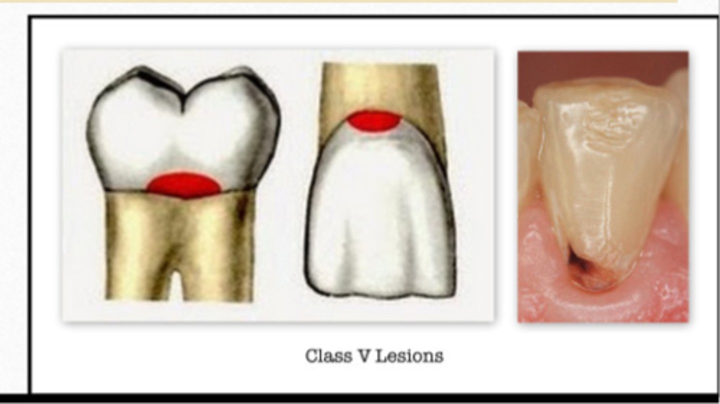 <p>GV Black Classification of Caries:</p><p>- Gingival 1/3</p><p>- B or L l surface of all teeth</p>
