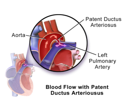 <ul><li><p>closure typically occurs by 2-4 days of age </p></li><li><p>essential for long-term survival </p></li><li><p>often linked to complex congenital heart issues </p></li></ul><p>clinical findings: - continuous murmur </p><p>Diagnosis: </p><ul><li><p>echocardiography: left to right shunting </p></li><li><p>mild left ventricular enlargement </p></li><li><p>scant pericardial effusion </p></li></ul><p>treatment: </p><ul><li><p>surgical closure using an Amplatz canine duct occluder (ACDO) </p></li></ul><p></p>