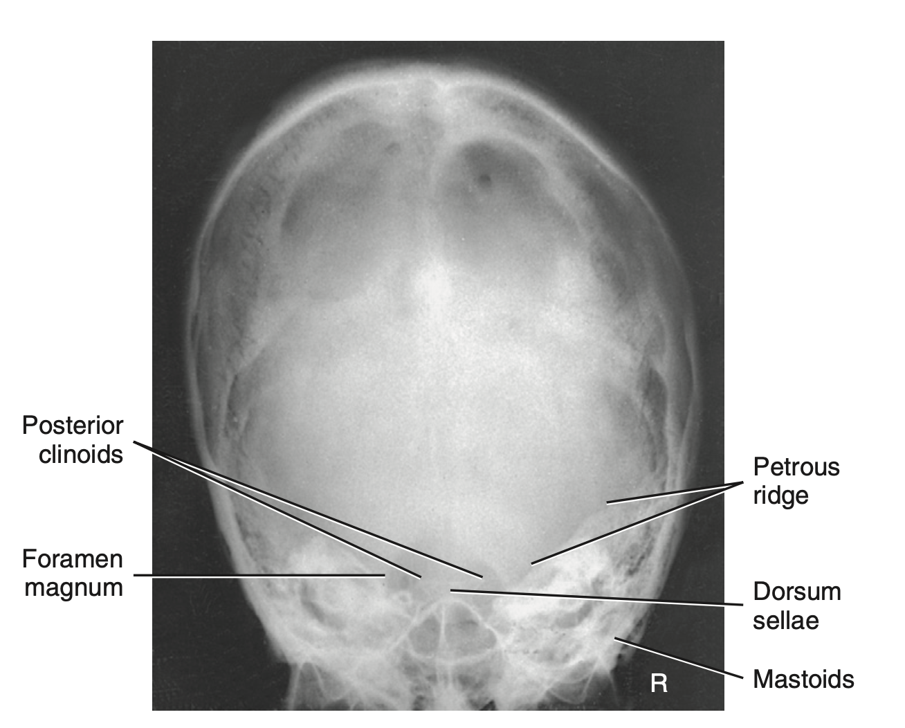 <p>Special: What is the <u>tube angle</u> used for <strong>PA axial (Haas method) </strong>for <strong>skull</strong>?</p>