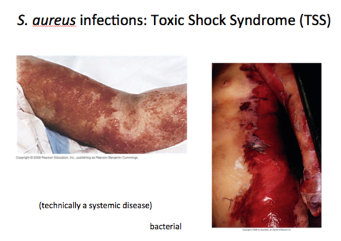 <p>Fever, vomiting, shock, and organ (ex: kidney) failure caused by toxic shock syndrome toxin 1 (TSST-1) in the bloodstream</p>