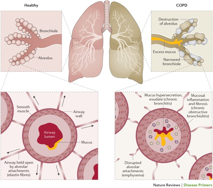 <p><u>Emfysem</u>: Inflammation i alveolerna leder till degenerering av väggarna och kärl genom bland annat <strong>elastase</strong> och <strong>MMP9</strong> → <em>minskad elasticitet</em> samtidigt som <em>infästningpunkter</em> mellan alveoler och bronkioler minskar. Det finns olika typer av emfysem:</p><ul><li><p>Paraseptal</p></li><li><p>Centeroacinär</p></li><li><p>Panacinär (överallt)</p></li></ul><p><u>Bronkiolit</u>: Inflammation i bronkiolerna som leder till <em>irreversibel fibros</em> som gör dessa stela och obstruktiva. Ökad produktion mucus och förträngningar i luftvägarna genom fibrotisering av fibroblaster. Förmedlas framförallt av <strong>makrofager</strong> och <strong>neutrofiler</strong>.</p>