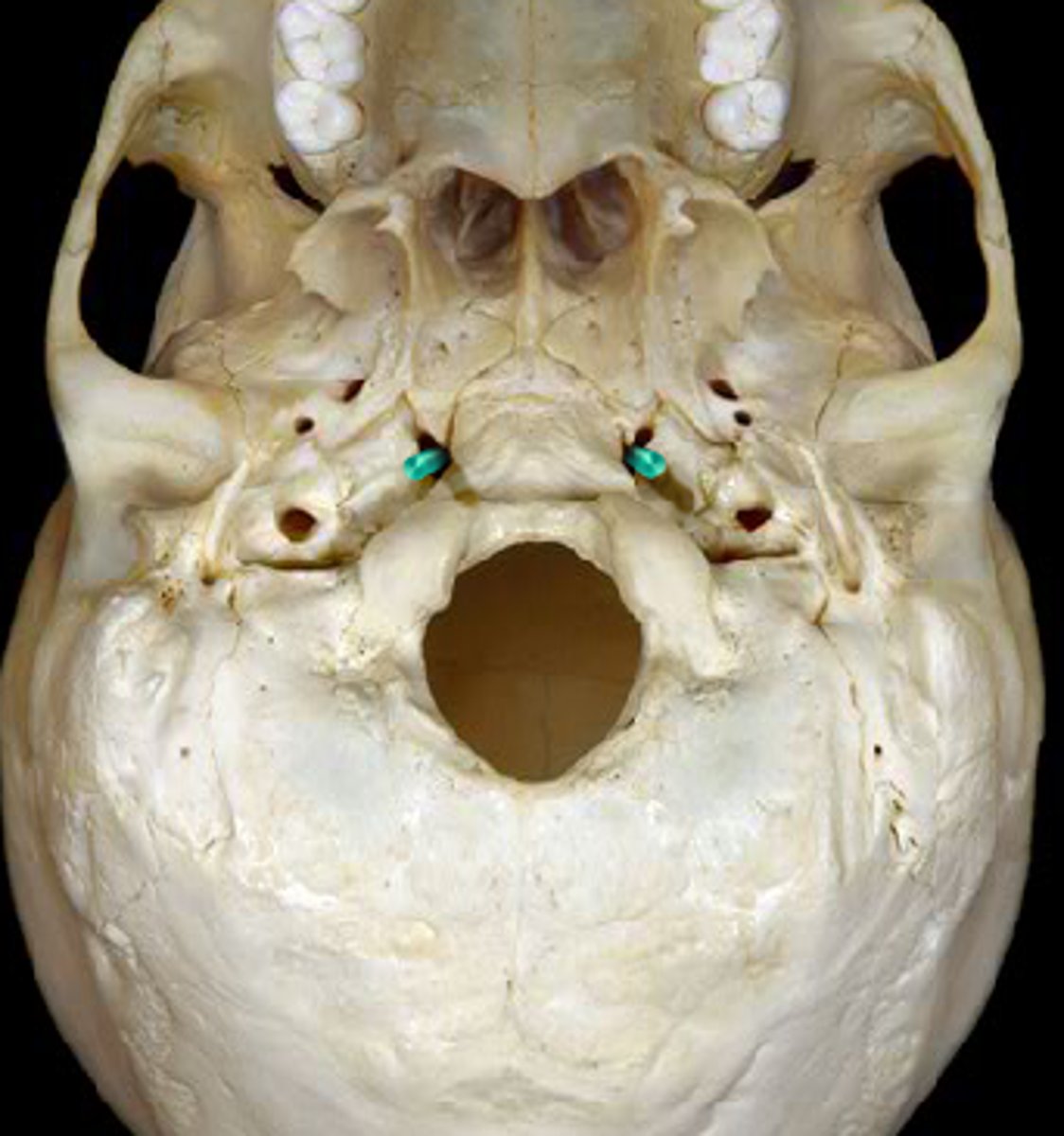 <p>Formed by Sphenoid, Temporal, and Occipital Bones</p>