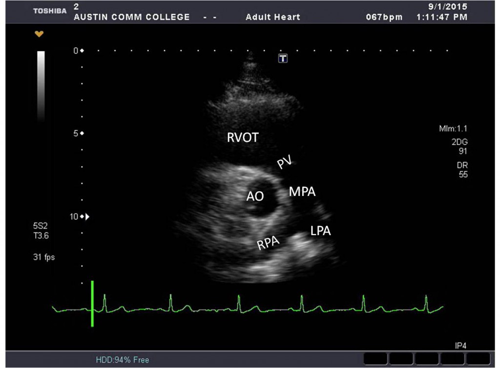 * RVOT
* MPA (RPA, LPA)
* PV
* Aorta (AO)
* Tricuspid valve (TV)
* Right atrium (RA)