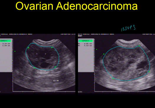 <ul><li><p><strong>Ovaries</strong></p><ul><li><p>caudal to the kidneys</p></li><li><p>not often seen but can be <strong>seen during estrus</strong></p></li><li><p>normal <strong>anechoic follicles</strong> <strong>just before ovulation</strong></p></li></ul></li><li><p><strong>Uterus</strong></p><ul><li><p><strong>Don’t see</strong> normally</p></li><li><p>Located just dorsal to bladder</p></li><li><p><strong>Post partum</strong></p><ul><li><p><strong>tubular mass dorsal to bladder</strong></p></li><li><p>Placental sites gone 4w</p></li><li><p>debris 3w</p></li><li><p><strong>Completed involution 4m</strong></p></li></ul></li></ul></li><li><p><strong>Pregnancy</strong></p><ul><li><p>detect pregnancy and viability</p><ul><li><p><strong>15d anechoic gestational sacs</strong> are seen</p></li><li><p>Nearly 100% accurate at 21d</p></li><li><p><strong>Heart beat by 21d</strong></p></li><li><p>movements seen at 28d</p></li><li><p>Internal organs 50d</p></li></ul></li><li><p>poor for counting fetuses</p></li></ul></li></ul><p></p>