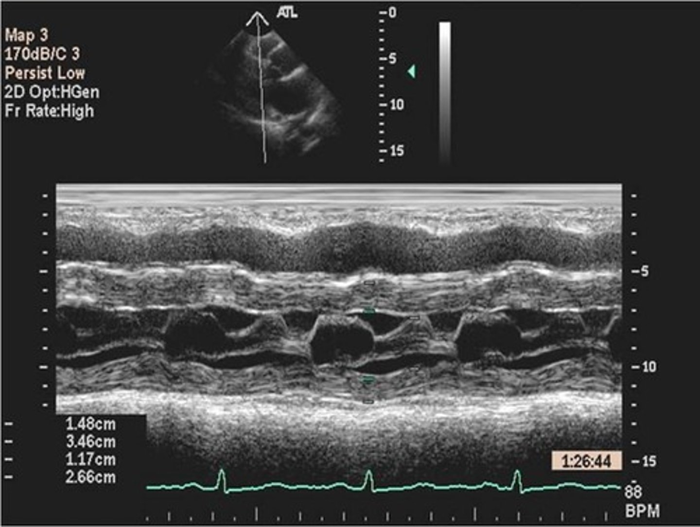 <p>MV leaflets move anteriorly towards the LVOT in systole; seen in hypertrophic cardiomyopathies such as ASH, IHSS, HOCM, and subaortic outflow tract obstruction</p>