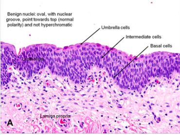 <ul><li><p><strong>can change shape</strong> to accommodate a volume change in the organ it lines</p></li><li><p>4-6 layers of dome-shaped cuboidal cells in its relaxed state</p></li><li><p>each surface cell appears umbrella shaped</p></li><li><p>found in <strong>bladder, major calcyes, and uterus</strong></p></li><li><p>Also known as <strong>urothelium</strong></p></li><li><p>When stretched, top layer dome-shaped cells become <strong>flat/squamous </strong>and epithelium becomes <strong>thin</strong></p></li></ul><p></p>
