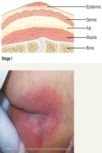 <p>Has Non blanchable redness to area, may be painful, or warm. Discoloration was last longer than 30 mins </p>