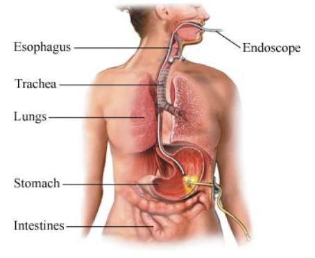 <ul><li><p>Placed via endoscope and guidewire pull through</p></li><li><p>Cheaper and quicker to perform</p></li></ul><p></p>