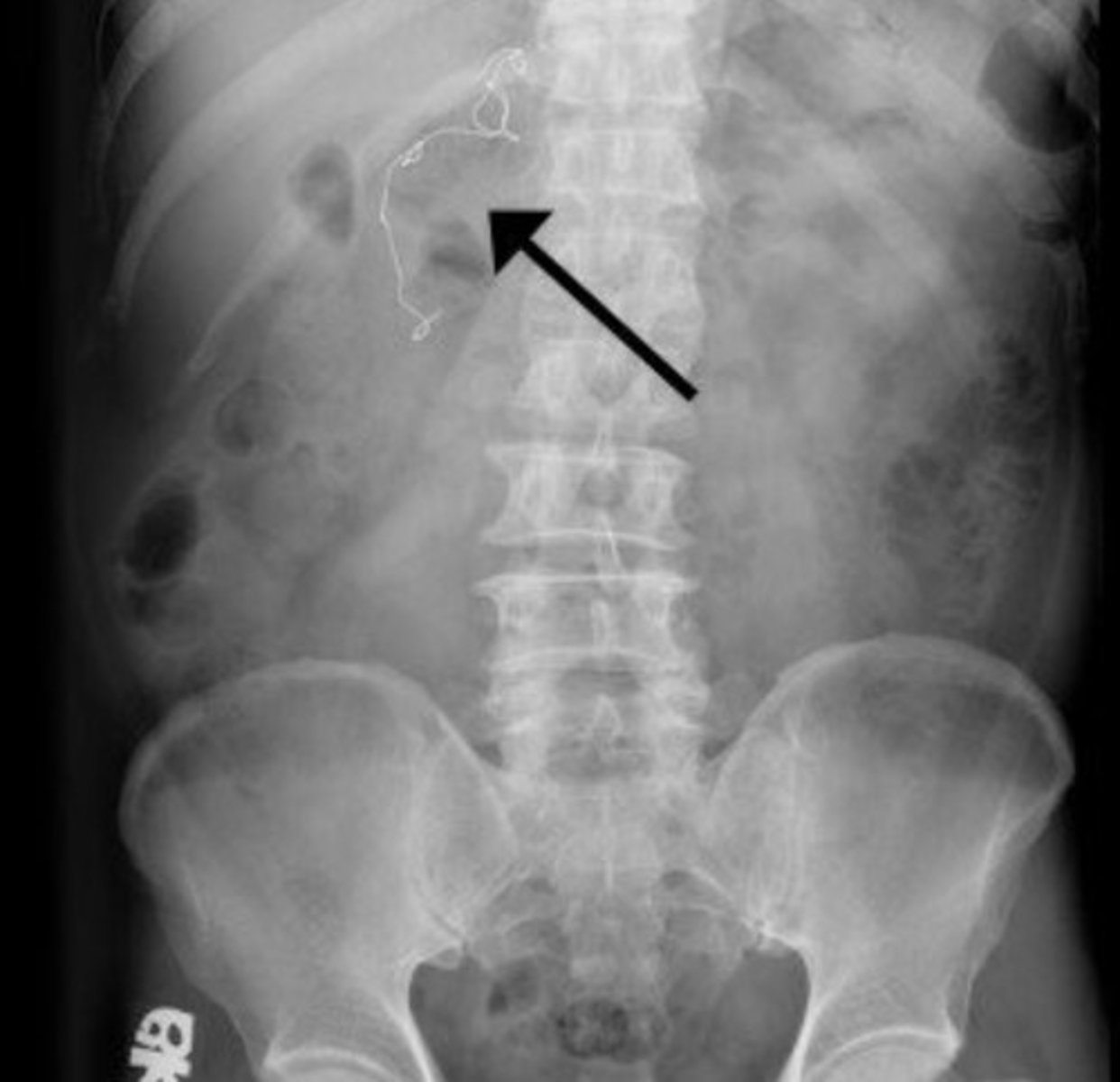 <p>event, incident, or condition that could have resulted or did result in harm to a patient</p>