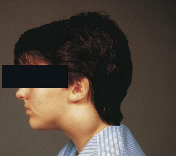 <p>The second pharyngeal or branchial grooves occasionally do not become obliterated and thus parts remain to form a <strong>___________</strong><em><span>.</span></em></p>