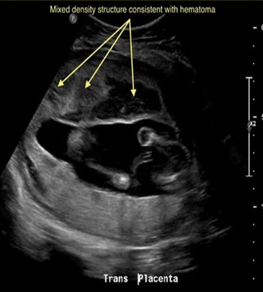 <p>a pt has 36w gestation w/<strong>acute</strong> onset of <strong>pain + bright red bleeding</strong>. she had 2 prior scans that were normal. what is the most common cause for the acute symptoms</p><p>a) placenta accreta</p><p>b) placenta abruption</p><p>c) placenta percreta</p><p>d) placenta previa</p>
