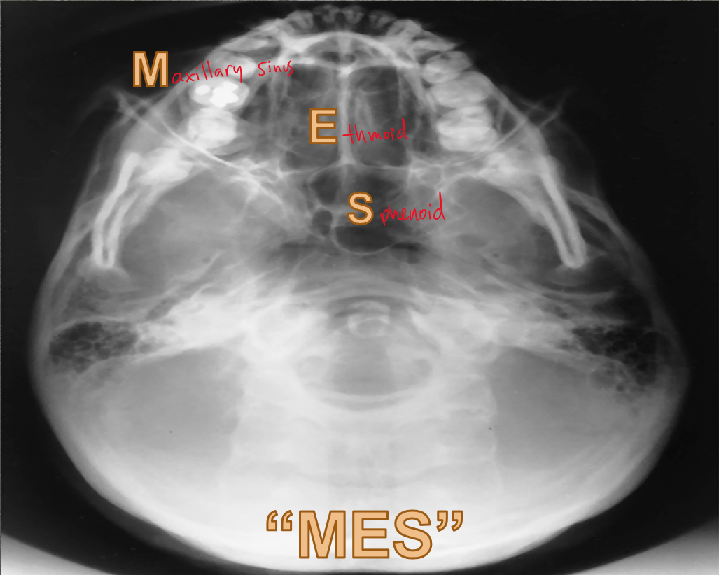 <p>Maxillary Sinus</p><p>Ethmoid</p><p>Sphenoid</p>