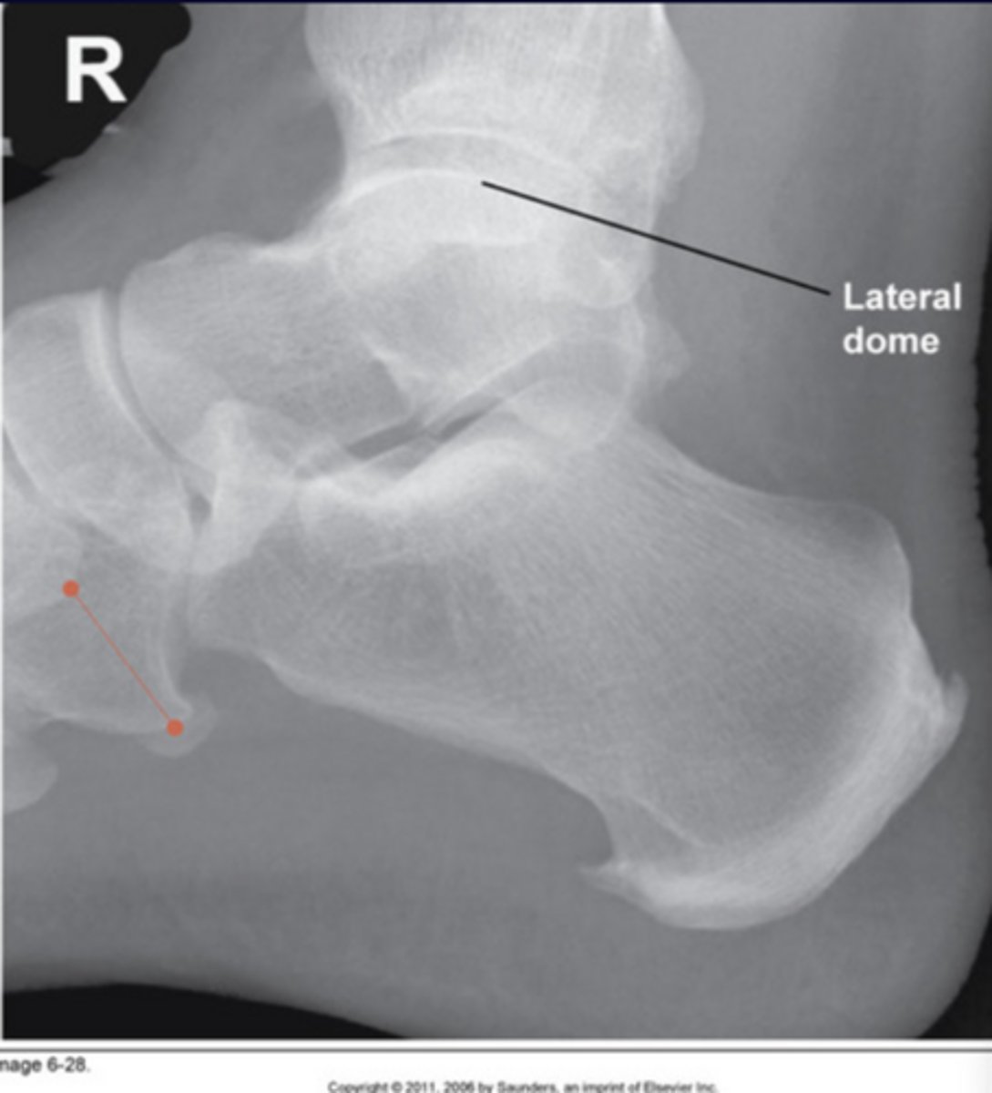 <p>Foot elevated</p>