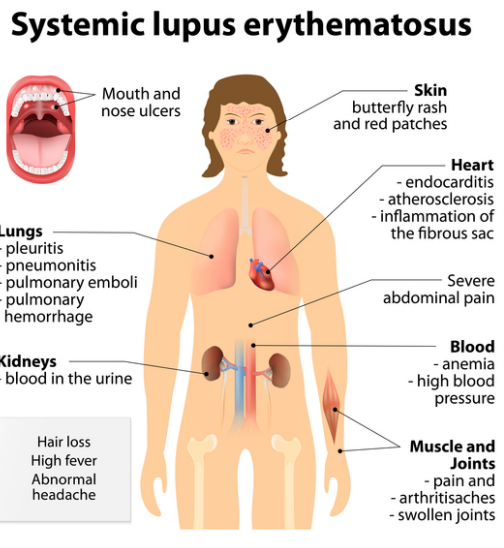 <p> Used to treat RA, SLE, and other autoimmune diseases</p><p>Also used in hypersensitivity and allergic reactions </p><p> Can reduce organ or graft rejection</p>