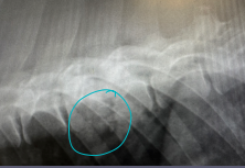 <p>Discospondylitis</p>