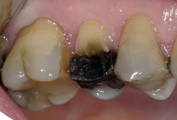 <p>The treatment plan for the fractured first premolar is to remove the</p><p>amalgam and restore with direct composite. Patient has normal symmetric</p><p>occlusion Reduction of the remaining cusp in this case ______ .</p><p>1) could enhance the fracture resistance of the restored tooth</p><p>2) could distribute the stresses more evenly on the restored structure</p><p>3) is recommended to follow cusp anatomy to create 2.5 - 3.0 mm thick</p><p>composite</p><p>4) is contraindicated in the most recent literature</p><p>5) is recommended as a thin 0.5 mm flat surface from the cusp tip</p><p>6) could improve retention by increasing the bonded surface area</p>