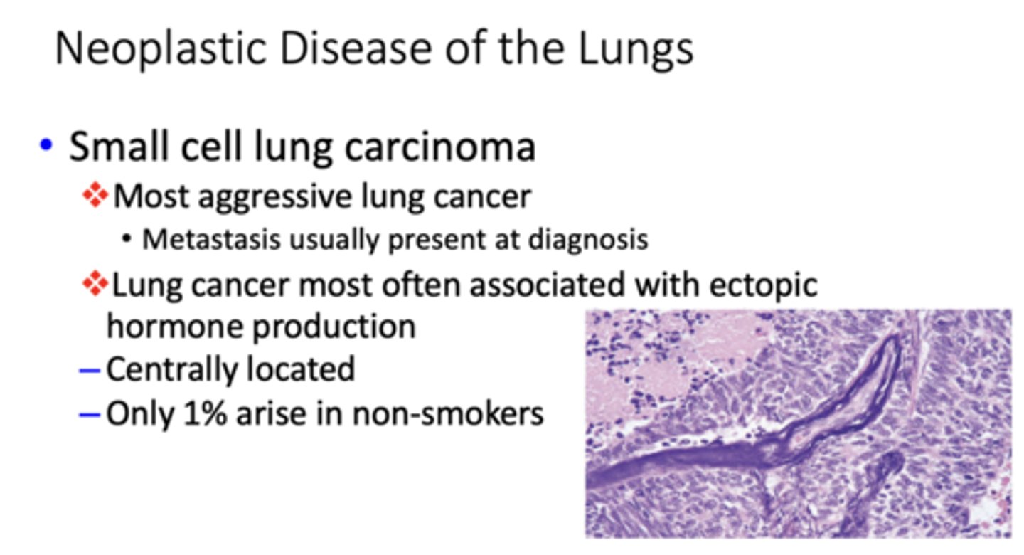 <p>small cell lung carcinoma</p>