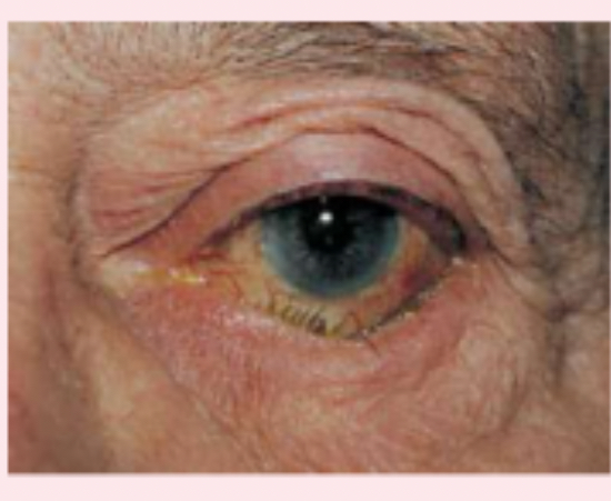 <p>inwardly turned lower eye lid</p>