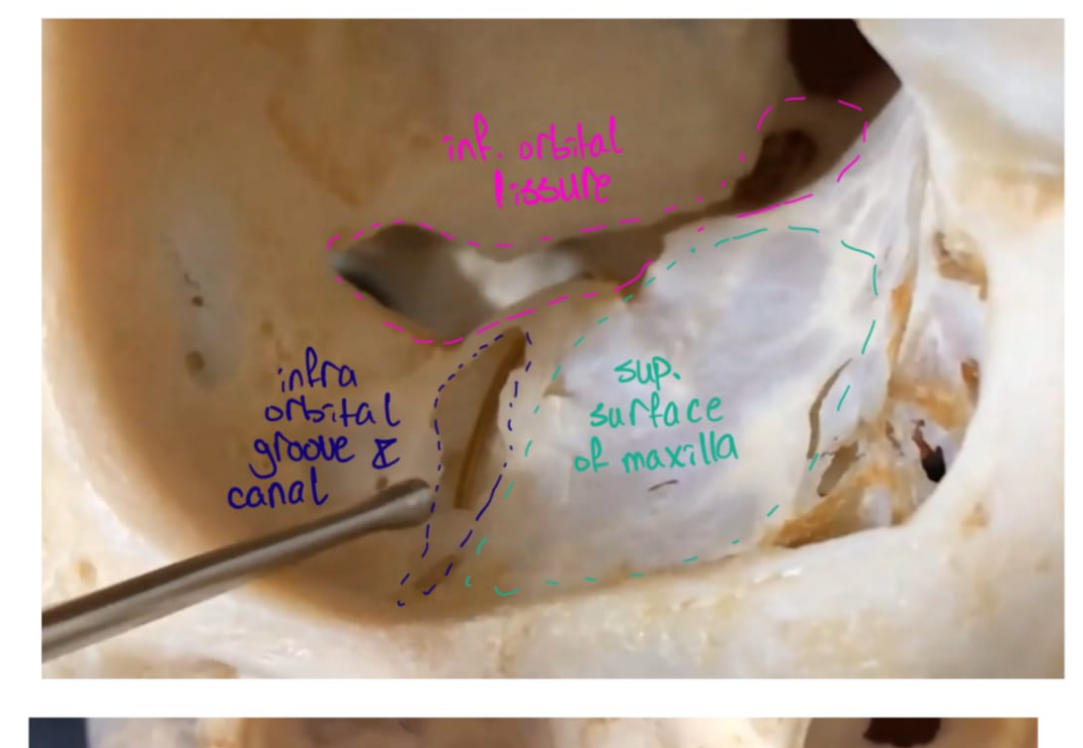 <p>Infraorbital groove, canal and foramen</p>