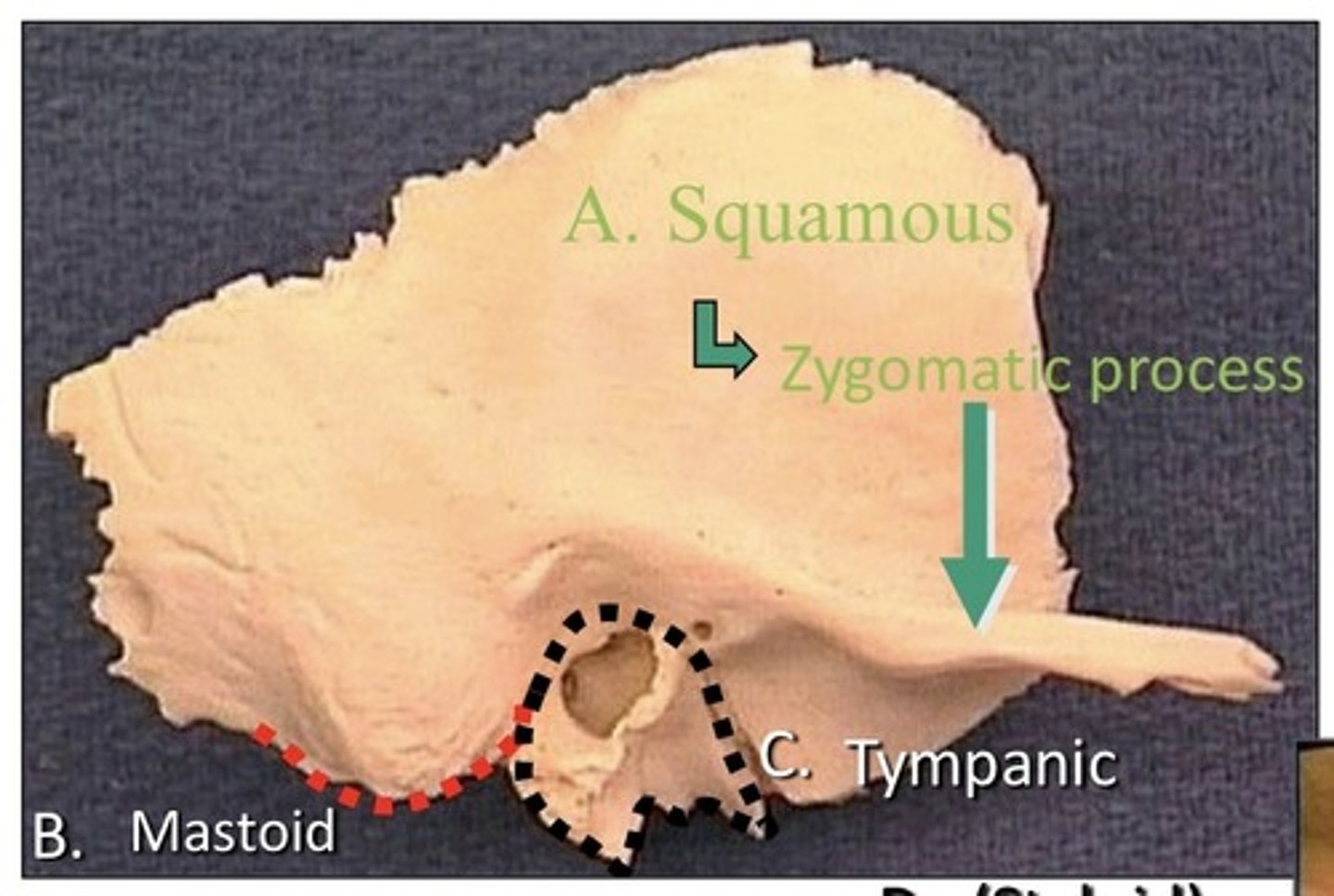 <p>1. Squamous</p><p>2. Tympanic</p><p>3. Petro-mastoid</p><p>4. Styloid</p><p>5. Has 4 parts</p><p>6. Paired bone</p><p>7. Lateral to sphenoid bone</p><p>8. Located in the middle cranial fossa</p><p>9. Anterior to occipital bone</p><p>10. Posterior to the frontal bone</p><p>11. Inferior to the parietal bone</p><p>12. Surrounds external auditory meatus</p><p>13. On the lateral aspect of the skull</p>