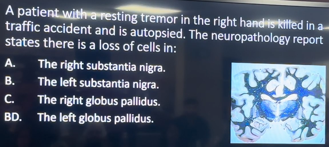 <p>A patient with a resting tremor in the right hand is killed in a traffic accident and is autopsied. The neuropathology report states there is a loss of cells in:</p><p>A. The right substantia nigra.<br>B. The left substantia nigra.<br>C. The right globus pallidus.<br>D. The left globus pallidus.</p>