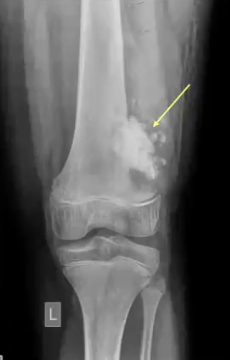 <p>MALIGNANT bone neoplasm, most commonly found in distal femur and proximal tibia </p>