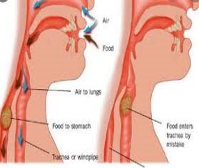 <p>Inspiration of foreign material into the airway</p>