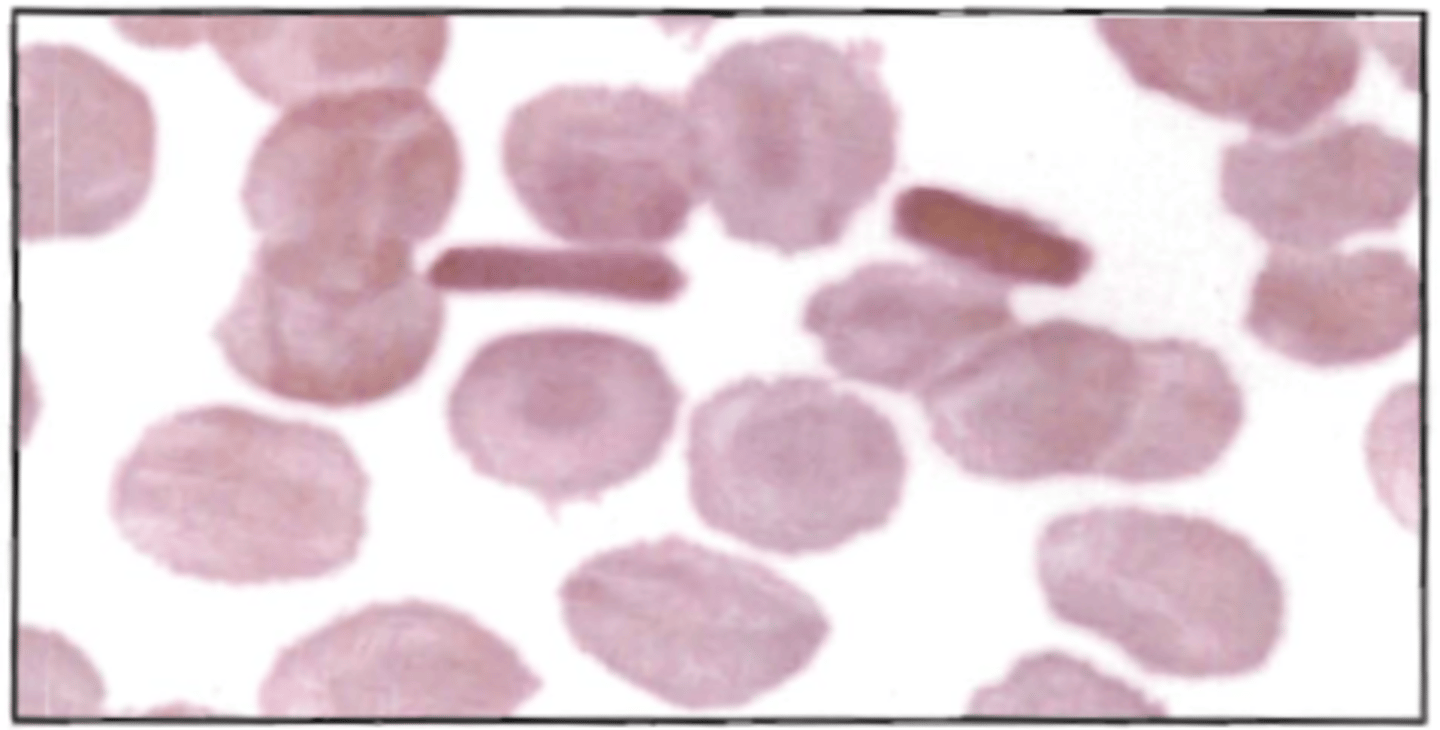 <p>75. The smear represented below displays:</p><p>A. congenital ovalocytosis</p><p>B. hemoglobin C disease</p><p>C. poor RBC fixation</p><p>D. delay in smear preparation</p>