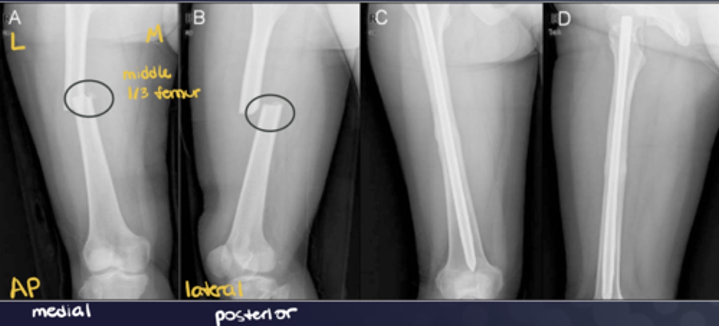 <p>DISTAL!! -- i.e., "displaced medial, posterior, and overriding"</p>