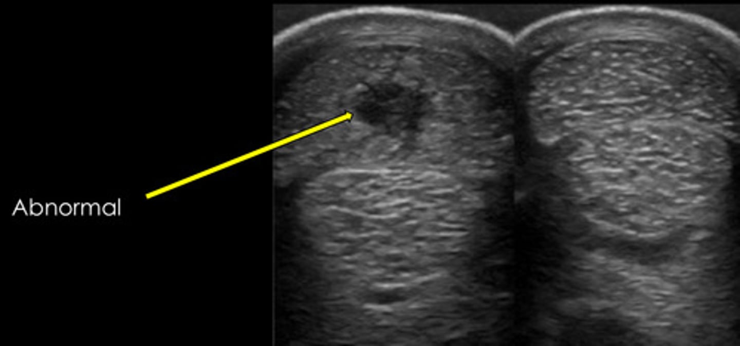 <p>What common lesion is shown? Fluid = edema = inflammation.</p>
