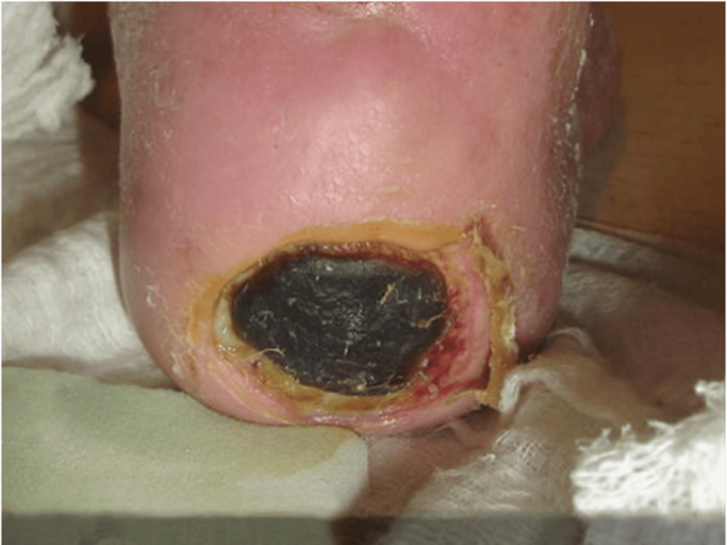 <p>Slough or eschar obscures the extent of tissue loss</p>