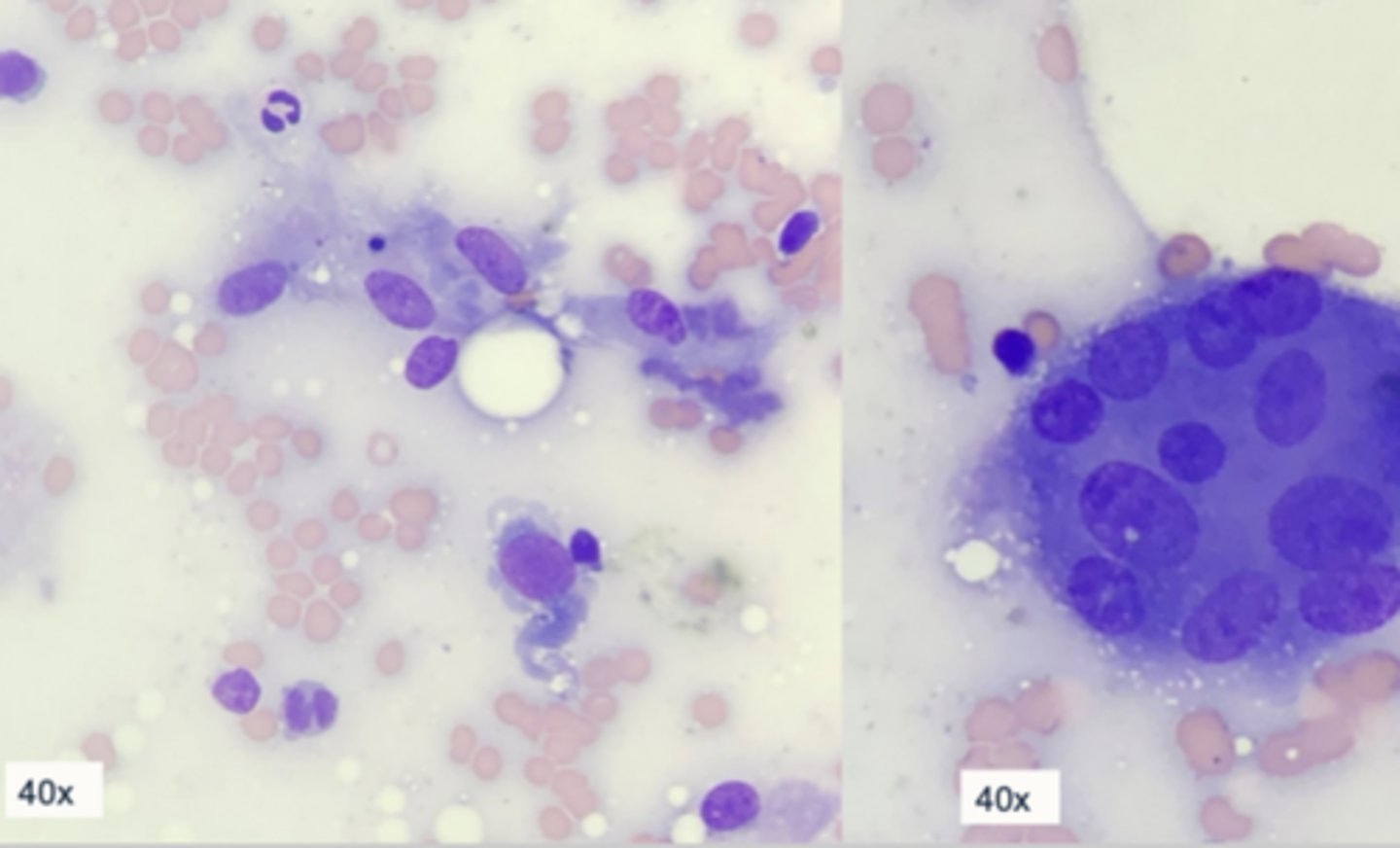 <p>Case 2 - Cytology</p><p>1. what is the cell harvest</p><p>2. how are the cells distributed</p><p>3. what are the shape of these cells</p><p>4. what cell type are they</p>