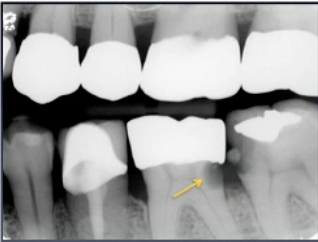 <p>what is this lesion </p>