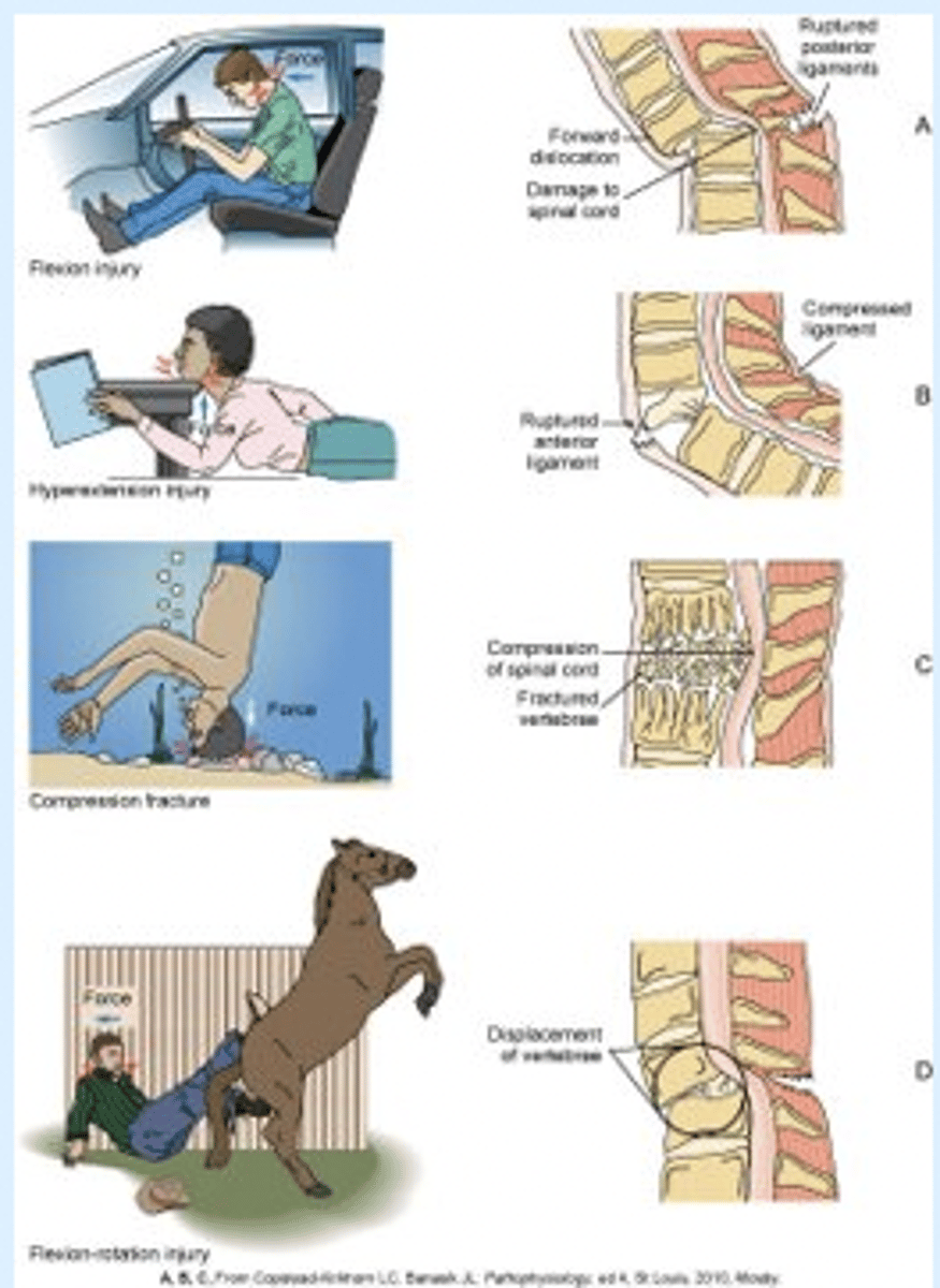 <p>Major __________ __ _______: </p><p>- flexion.</p><p>- hyperextension.</p><p>- flexion–rotation.</p><p>- extension–rotation.</p><p>- compression.</p>