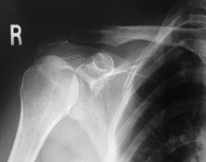 <p>evaluation criteria for AP shoulder neutral rotation </p>
