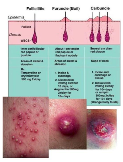 <p>Furuncle (boil): deep infection of hair follicle →</p><p>abscess</p><p>Carbuncle: cluster of interconnected furuncles</p><p>Main pathogen: </p><ul><li><p>Staphylococcus aureus</p></li></ul><p>Clinical: painful, red, fluctuant nodules with pus</p><p>Treatment: incision & drainage ± antibiotics (MRSA</p><p>coverage if needed)</p>