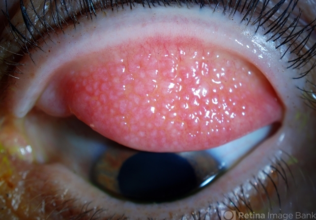 <ul><li><p><span>Discrete raised lesions with a </span><span style="color: red"><strong>central vascular core</strong>&nbsp;</span></p></li><li><p><span>Macro papillae &lt;1mm diameter</span></p></li><li><p><span>Giant papillae &gt;1mm diameter</span></p></li><li><p><span><strong>Indicate prolonged inflammation has been present</strong></span></p></li></ul><p></p>