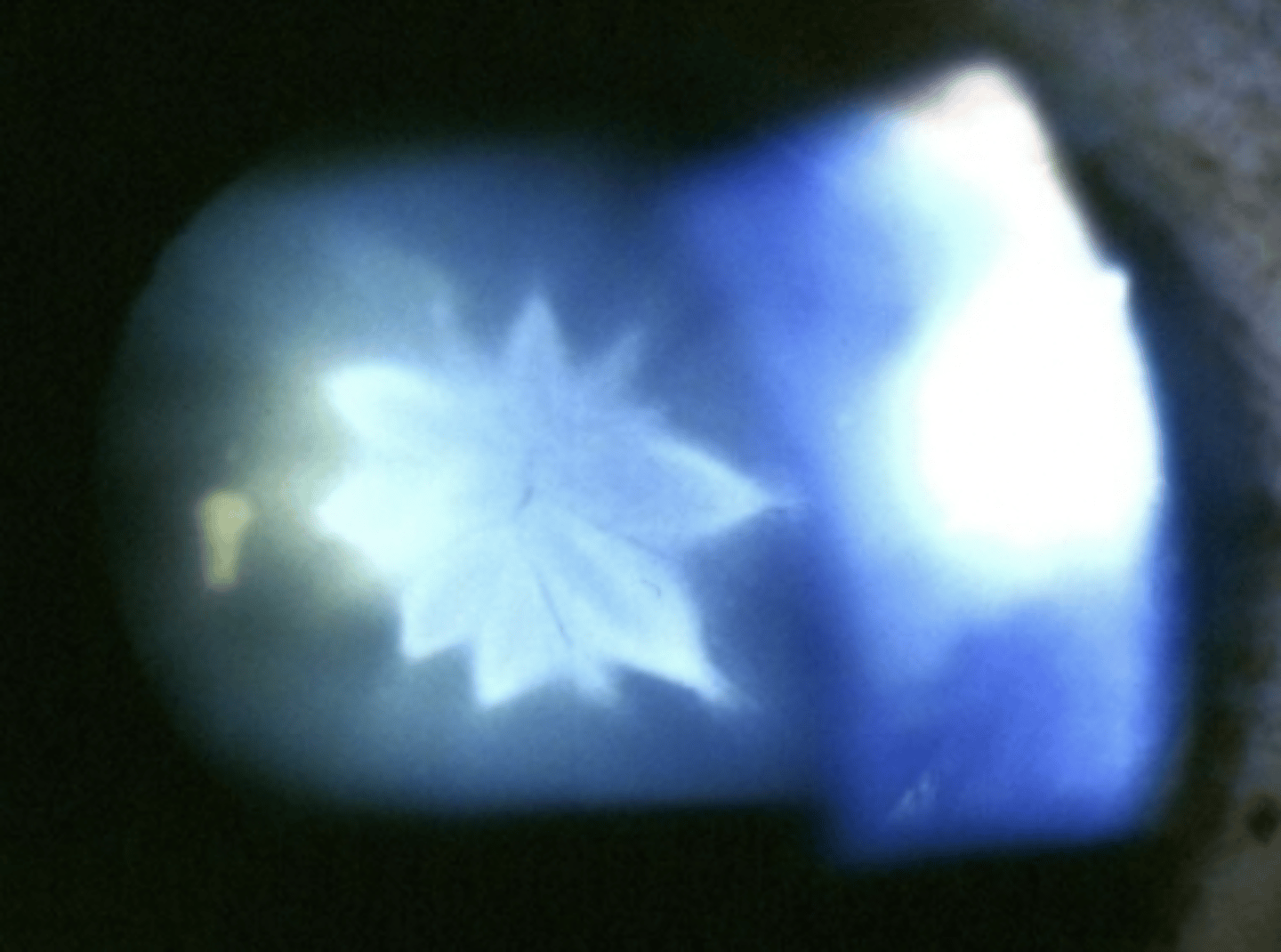 <p><u>Etio</u>: younger ppl, secondary to blunt or penetrating ocular trauma, infrared energy, electric shock, ionizing radiation</p><p><u>S&amp;S</u>: may cause blindness, blurred vision - may present as acute, subacute, or late sequela of ocular trauma</p><p><u>Testing:</u> dilated eye with slit lamp</p><p><u>Tx</u>: emergent referral to optho; surgery, prevent injury</p>