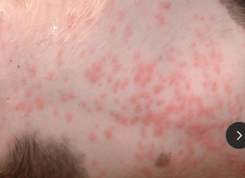 <p><span>Elevated Solid Primary Lesions</span></p>