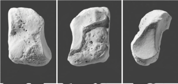 <p>Has a distinct tear-drop shaped articular surface. Largest of the three</p>