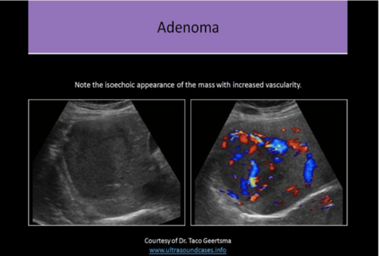 <p>1. KEY FINDINGS= HYPERVASCULAR, WITH OR WITHOUT HEMORRHAGE, IN YOUNG WOMEN ON ORAL CONTRACEPTIVES<br>2. solitary<br>3. well defined, solid mass<br>4. VARYING echogenicity, usually HYPOECHOIC<br>5. HETEROGENEOUS<br>6. increased vascularity with possible internal hemorrhage<br>7. cannot be differentiated from FNH on standard US exam<br>8. CENTRIPETAL enhancement</p>