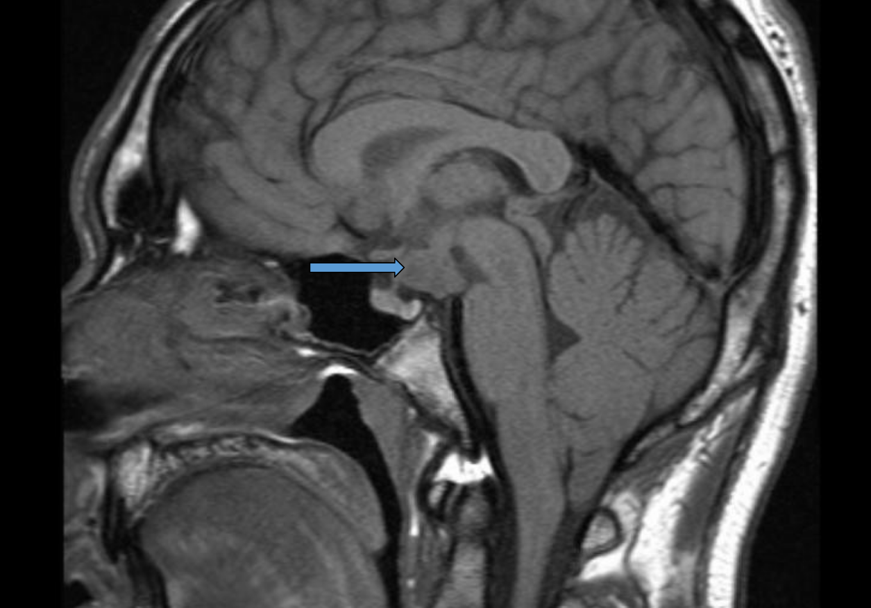<p>patient presents with auditory hallucinations, sexual aggressiveness, destructive behavior, hypersomnolence, most likely ____ _____ syndrome (sleeping beuty syndrome), MRI shows patietn with tumor where _______ should be </p>