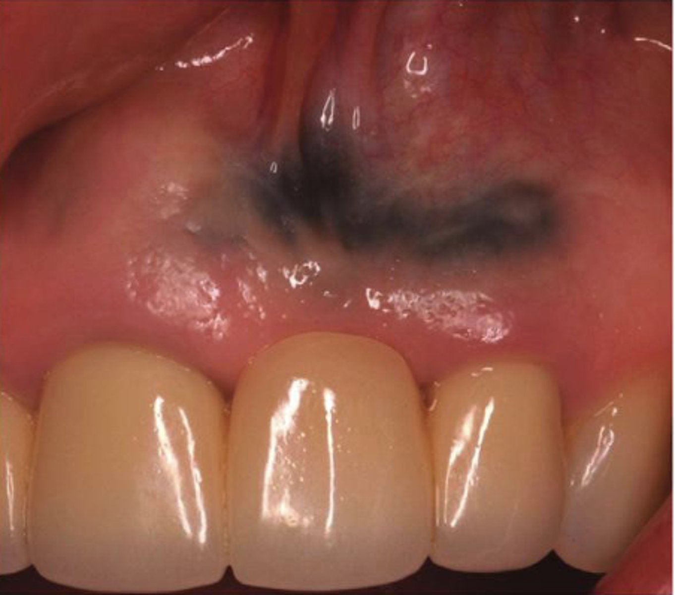 <p>What type of pigmented lesion?</p>