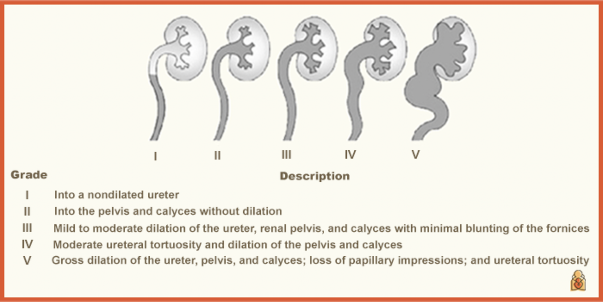 <ol><li><p><span>Into a non-dilated ureter</span></p></li><li><p><span>Into the pelvis and calyces without dilation</span></p></li><li><p><span>Mild to moderate dilation of the ureter, renal pelvis and calyces with minimal blunting of the fornices</span></p></li><li><p><span>Moderate ureteral tortuosity and dilation of the pelvis and calyces</span></p></li><li><p><span>Gross dilation of the ureter, pelvis and calyces, loss of papillary impressions and ureteral tortuosity</span></p></li></ol><p></p>