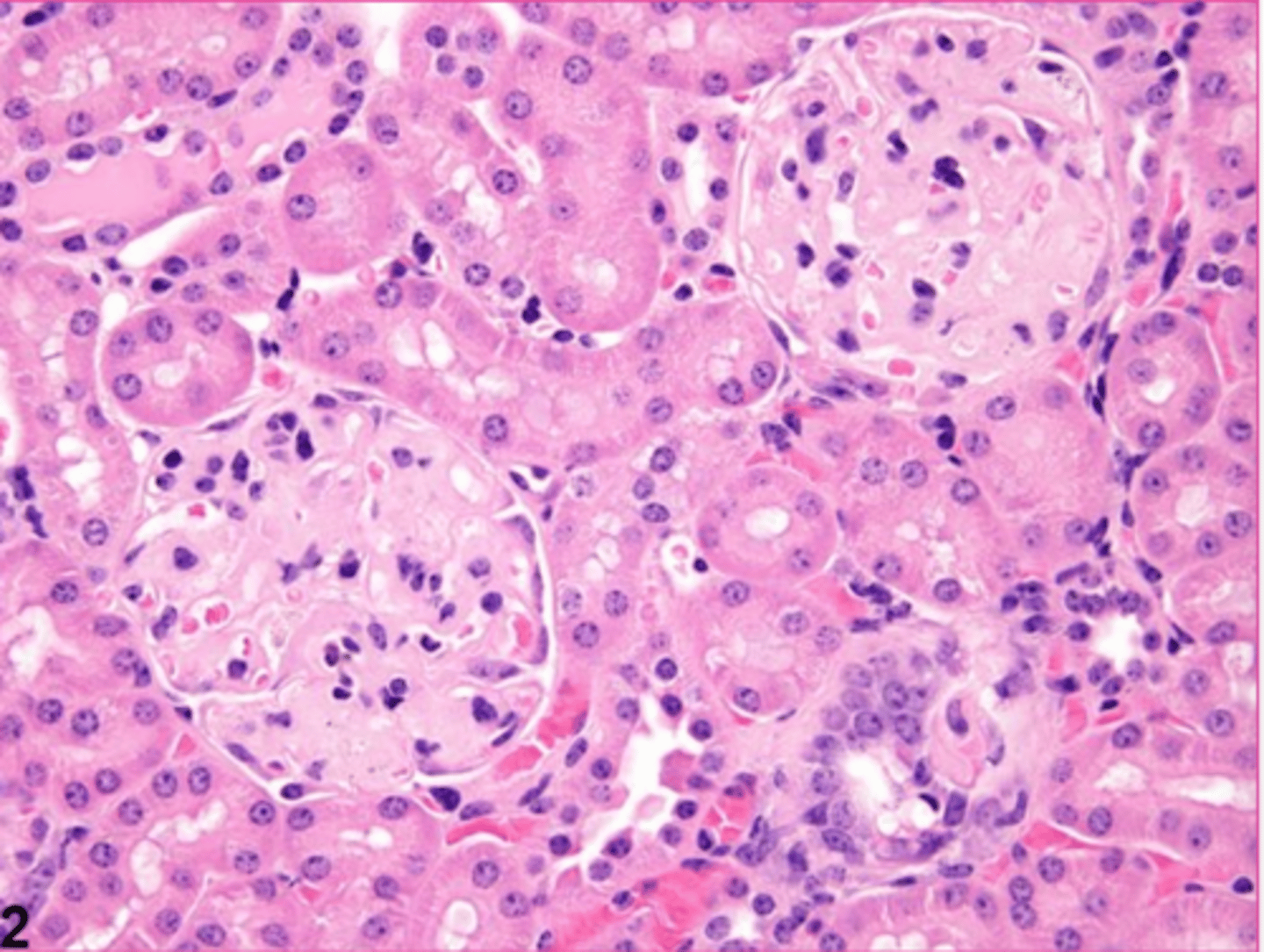 <p>Which type of amyloid?</p>